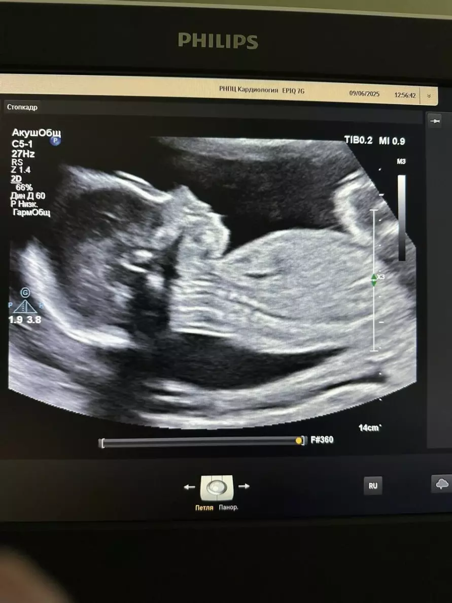 Белорусские кардиохирурги впервые успешно удалили опухоль ещё не родившемуся малышу