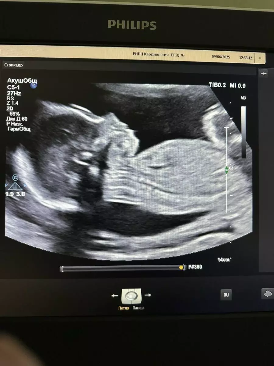 Белорусские кардиохирурги впервые успешно удалили опухоль ещё не родившемуся малышу