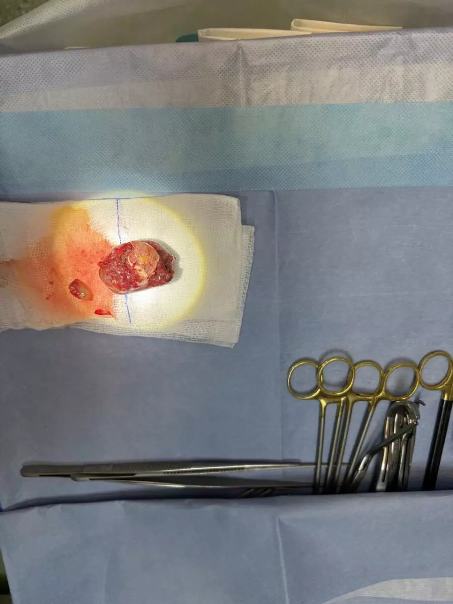 Белорусские кардиохирурги впервые успешно удалили опухоль ещё не родившемуся малышу