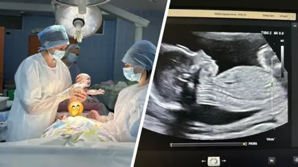 Белорусские кардиохирурги впервые успешно удалили опухоль ещё не родившемуся малышу